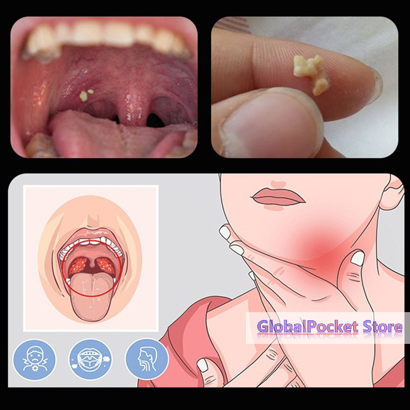 [TG823]Ear Wax Tonsil Stone Re - Ear Wax Remover review and price